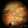 Endo lesions infiltration