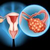 latest research endometriosis